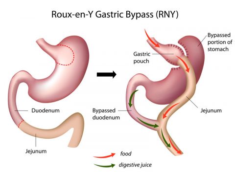 Gastric ByPass Paris | France | Dr. Bruto Randone Digestive and Bariatric Surgeon | OBESITY SURGERY PARIS