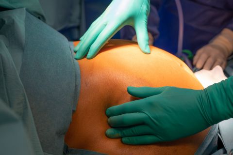 Chirurgie plastique et perte de poids massive : approches, interventions et  questions fréquentes - docteurisola-esthetique, amaigrissement et perte de  poids 